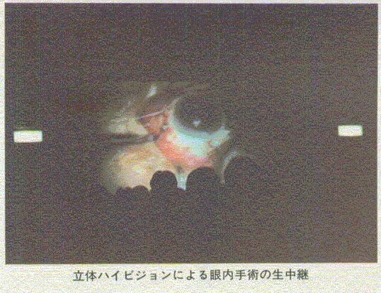 立体ハイビジョンによる眼内手術の生中継